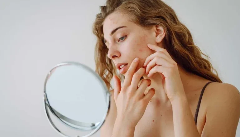 Hızlı sivilce tedavisi için önerilen 6 yöntem açıklandı